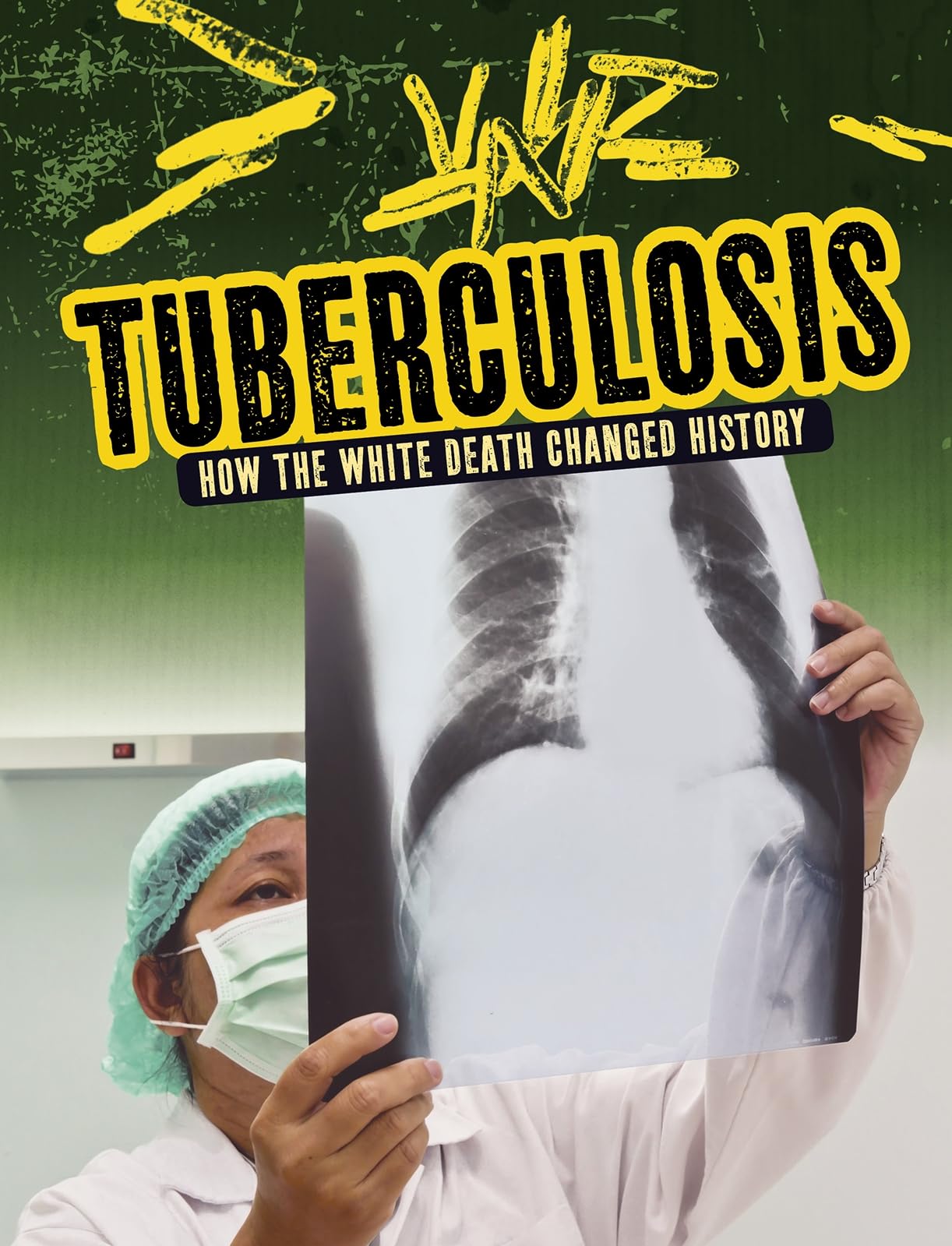Tuberculosis by Mark K. Lewis